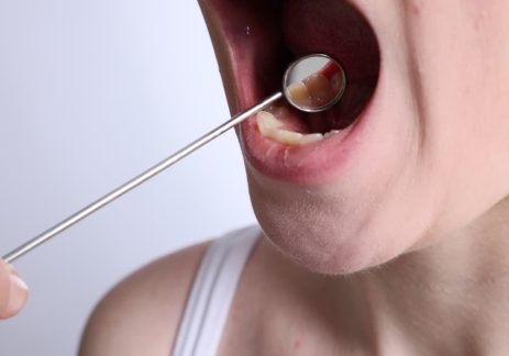 Stay Safe This November with Oral Cancer Screening at Hoburne Dental Practice