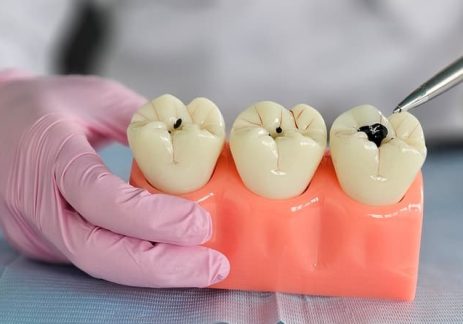 Fluoride and Dental Decay: Protecting Your Teeth for Life