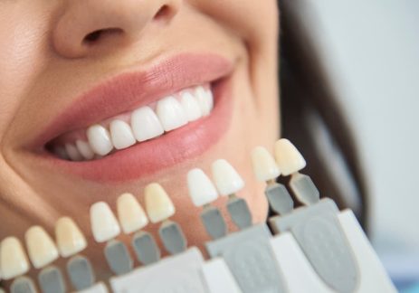 Professional Tooth Whitening in Christchurch – What to Expect