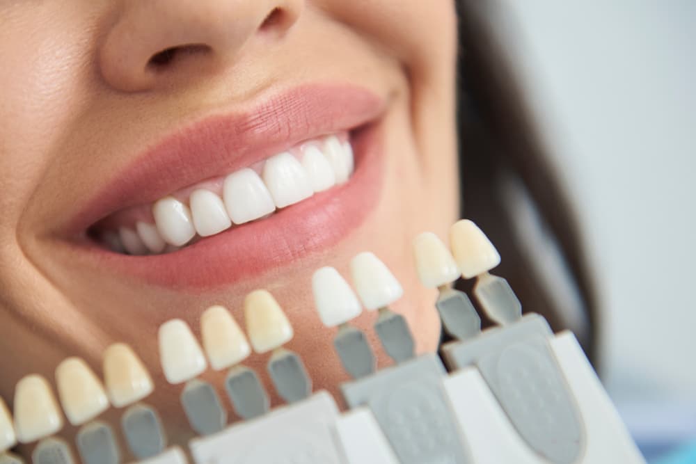 professional teeth whitening